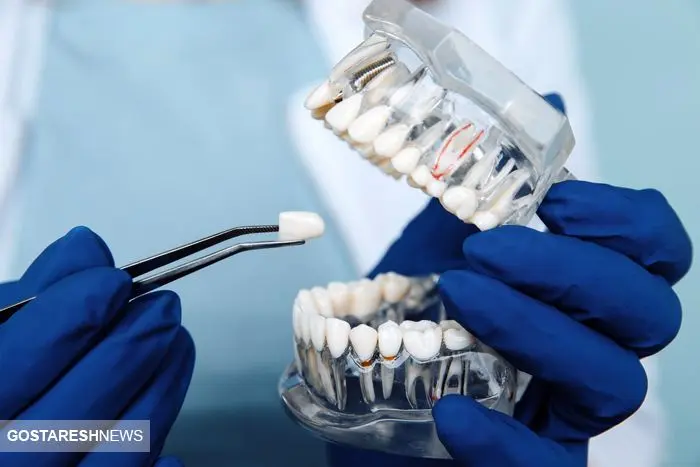 تعرفه‌های ۱۴۰۴ خدمات دندان پزشکی اعلام شد | کامپوزیت هر فک چند ؟