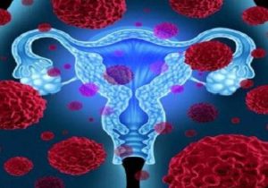 فیبروم رحمی با خطر بیماری قلبی در زنان مرتبط است