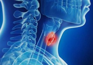 افزایش آمار تشخیص بدخیمی‌های تیروئیدی
