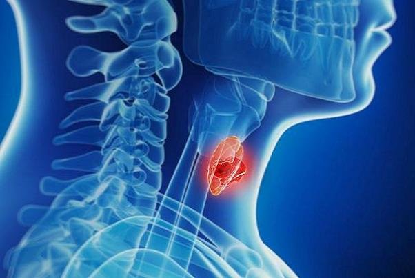 افزایش آمار تشخیص بدخیمی‌های تیروئیدی