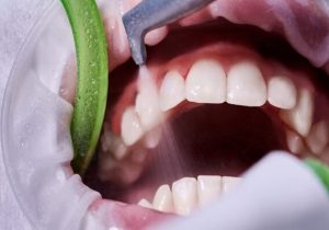 جرم‌گیری، راهی موثر برای پیشگیری از پوسیدگی و بیماری لثه