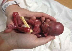 سقط جنین؛ از «صنعت پول‌های سیاه» تا عوارض جبران‌ناپذیر جسمی و روانی