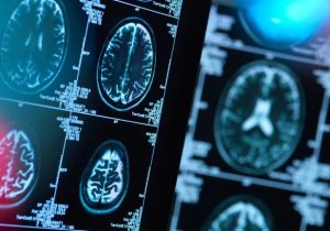 هشدار به بیماران صرعی و آسمی درباره قطع دارو در ایام روزه‌داری